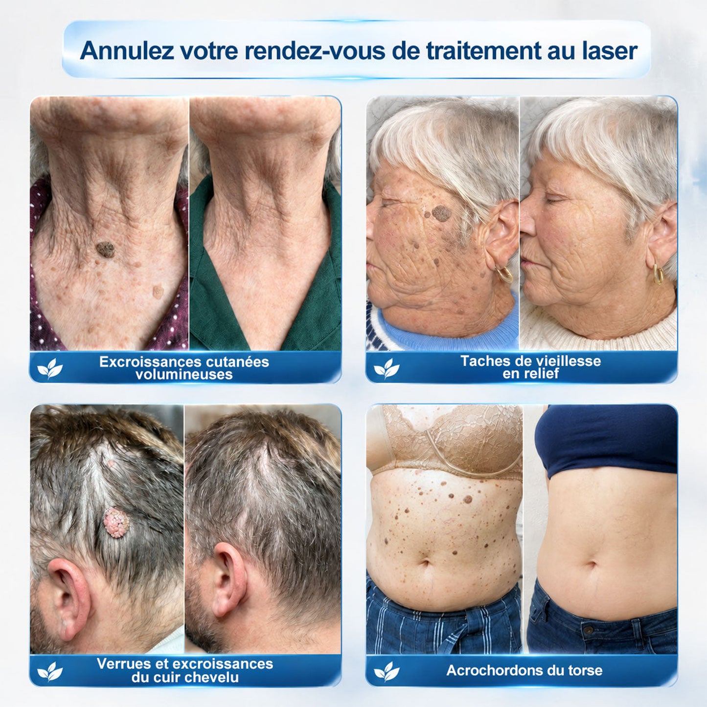 Boutique officielle de la marque |🖊️GFOUK® 7 Jours Effaceur de taches et d’excroissances cutanées(Zéro douleur, zéro cicatrice – Roller)🪴