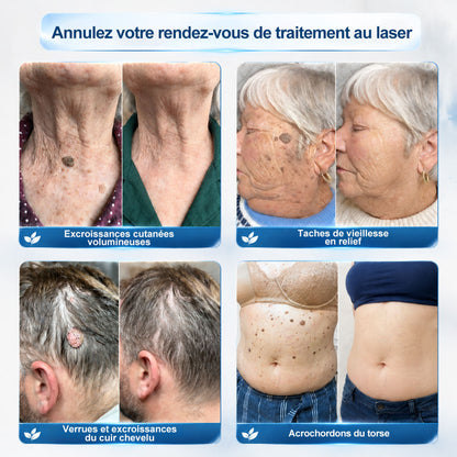 Boutique officielle de la marque |🖊️GFOUK® 7 Jours Effaceur de taches et d’excroissances cutanées(Zéro douleur, zéro cicatrice – Roller)🪴