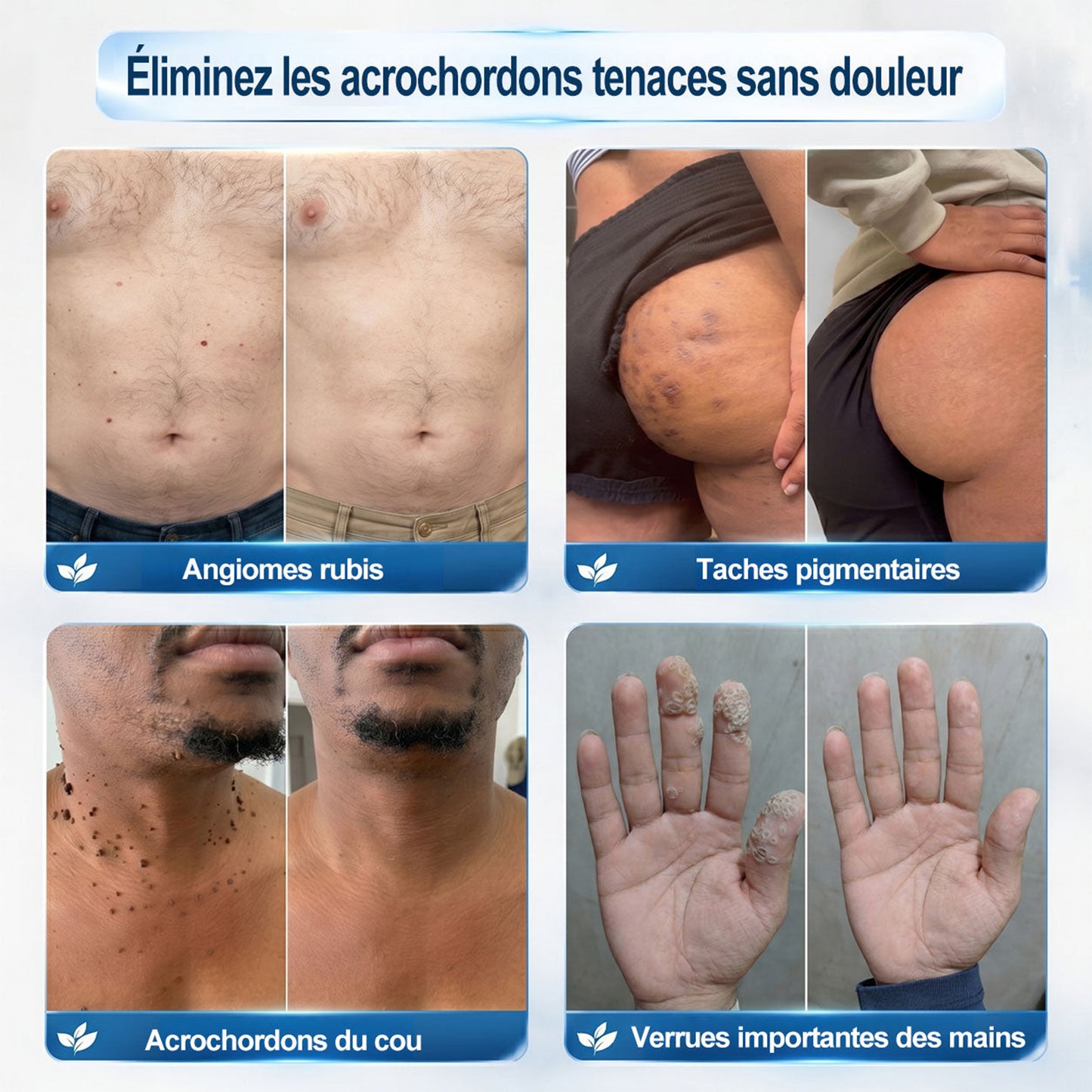 Boutique officielle de la marque |🖊️GFOUK® 7 Jours Effaceur de taches et d’excroissances cutanées(Zéro douleur, zéro cicatrice – Roller)🪴