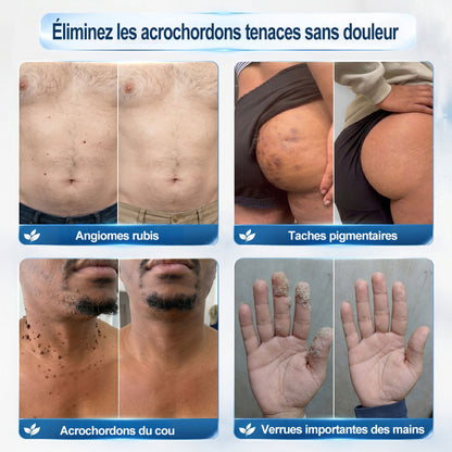 Boutique officielle de la marque |🖊️GFOUK® 7 Jours Effaceur de taches et d’excroissances cutanées(Zéro douleur, zéro cicatrice – Roller)🪴