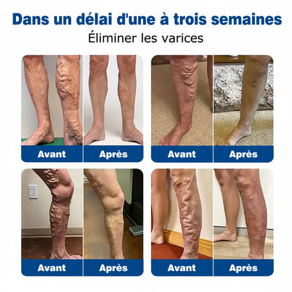 🇫🇷 🌵𝗣𝗮𝘁𝗰𝗵 𝗱𝗲 𝘀𝗼𝗶𝗻 𝗱𝗲𝘀 𝘃𝗲𝗶𝗻𝗲𝘀 𝗚𝗙𝗢𝗨𝗞® 𝗩𝗲𝗶𝗻𝗘𝗮𝘀𝗲 à 𝗺𝗶𝗰𝗿𝗼-𝗮𝗶𝗴𝘂𝗶𝗹𝗹𝗲𝘀⚡𝗦𝗼𝘂𝗹𝗮𝗴𝗲𝗺𝗲𝗻𝘁 𝗶𝗻𝘀𝘁𝗮𝗻𝘁𝗮𝗻é, 𝗿é𝘀𝘂𝗹𝘁𝗮𝘁𝘀 à 𝗹𝗼𝗻𝗴 𝘁𝗲𝗿𝗺𝗲💙