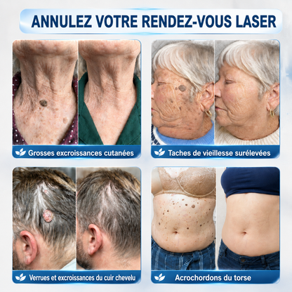 👩‍⚕️💕 𝐵𝑜𝑢𝑡𝑖𝑞𝑢𝑒 𝑂𝑓𝑓𝑖𝑐𝑖𝑒𝑙𝑙𝑒 | GFOUK® 🌿𝑴𝒊𝒄𝒓𝒐𝒏𝒆𝒆𝒅𝒍𝒆𝒔 𝑷𝒆𝒂𝒖 𝑷𝒂𝒓𝒇𝒂𝒊𝒕𝒆 É𝒍𝒊𝒎𝒊𝒏𝒂𝒕𝒊𝒐𝒏 𝑫𝒆𝒔 𝑽𝒆𝒓𝒓𝒖𝒆𝒔 𝑷𝒂𝒕𝒄𝒉 (𝑃𝑜𝑢𝑟 𝑙𝑒𝑠 𝑎𝑐𝑟𝑜𝑐ℎ𝑜𝑟𝑑𝑜𝑛𝑠, 𝑙𝑒𝑠 𝑝𝑒𝑡𝑖𝑡𝑒𝑠 𝑒𝑥𝑐𝑟𝑜𝑖𝑠𝑠𝑎𝑛𝑐𝑒𝑠 𝑐𝑢𝑡𝑎𝑛é𝑒𝑠, 𝑙𝑒𝑠 𝑣𝑒𝑟𝑟𝑢𝑒𝑠, 𝑙𝑒𝑠 𝑔𝑟𝑎𝑖𝑛𝑠 𝑑𝑒 𝑏𝑒𝑎𝑢𝑡é, 𝑙𝑒𝑠 𝑡𝑎𝑐ℎ𝑒𝑠 𝑑𝑒 𝑣𝑖𝑒𝑖𝑙𝑙𝑒𝑠𝑠𝑒 𝑒𝑡 𝑙𝑒𝑠 𝑝𝑟𝑜𝑏𝑙è𝑚𝑒𝑠 𝑑𝑒 𝑝𝑖𝑔𝑚𝑒𝑛𝑡𝑎𝑡𝑖𝑜𝑛)