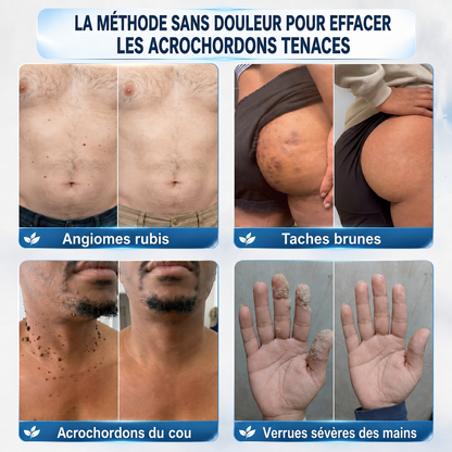 👩‍⚕️💕 𝐵𝑜𝑢𝑡𝑖𝑞𝑢𝑒 𝑂𝑓𝑓𝑖𝑐𝑖𝑒𝑙𝑙𝑒 | GFOUK® 🌿𝑴𝒊𝒄𝒓𝒐𝒏𝒆𝒆𝒅𝒍𝒆𝒔 𝑷𝒆𝒂𝒖 𝑷𝒂𝒓𝒇𝒂𝒊𝒕𝒆 É𝒍𝒊𝒎𝒊𝒏𝒂𝒕𝒊𝒐𝒏 𝑫𝒆𝒔 𝑽𝒆𝒓𝒓𝒖𝒆𝒔 𝑷𝒂𝒕𝒄𝒉 (𝑃𝑜𝑢𝑟 𝑙𝑒𝑠 𝑎𝑐𝑟𝑜𝑐ℎ𝑜𝑟𝑑𝑜𝑛𝑠, 𝑙𝑒𝑠 𝑝𝑒𝑡𝑖𝑡𝑒𝑠 𝑒𝑥𝑐𝑟𝑜𝑖𝑠𝑠𝑎𝑛𝑐𝑒𝑠 𝑐𝑢𝑡𝑎𝑛é𝑒𝑠, 𝑙𝑒𝑠 𝑣𝑒𝑟𝑟𝑢𝑒𝑠, 𝑙𝑒𝑠 𝑔𝑟𝑎𝑖𝑛𝑠 𝑑𝑒 𝑏𝑒𝑎𝑢𝑡é, 𝑙𝑒𝑠 𝑡𝑎𝑐ℎ𝑒𝑠 𝑑𝑒 𝑣𝑖𝑒𝑖𝑙𝑙𝑒𝑠𝑠𝑒 𝑒𝑡 𝑙𝑒𝑠 𝑝𝑟𝑜𝑏𝑙è𝑚𝑒𝑠 𝑑𝑒 𝑝𝑖𝑔𝑚𝑒𝑛𝑡𝑎𝑡𝑖𝑜𝑛)